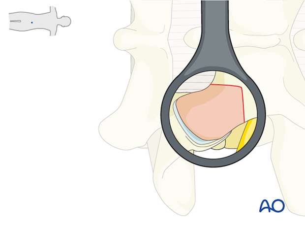 Resection of the inferior articular process during MISS Transforaminal lumbar interbody fusion (TLIF)