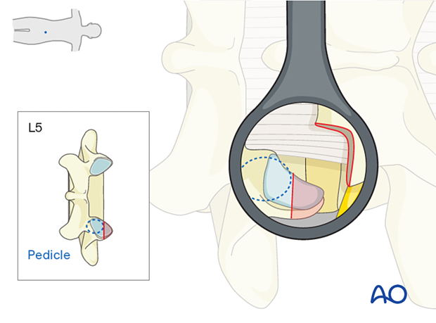 Resection of the superior articular process during MISS Transforaminal lumbar interbody fusion (TLIF)