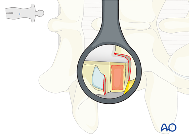 Opening the disc during MISS Transforaminal lumbar interbody fusion (TLIF)