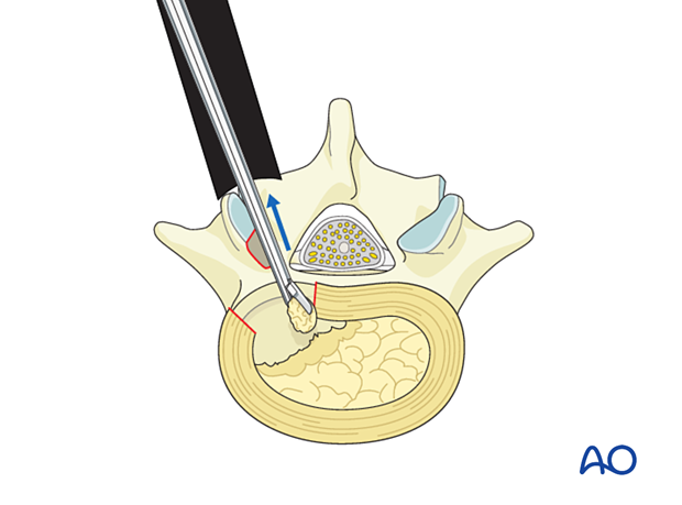 Performing a piecemeal discectomy during MISS Transforaminal lumbar interbody fusion (TLIF)