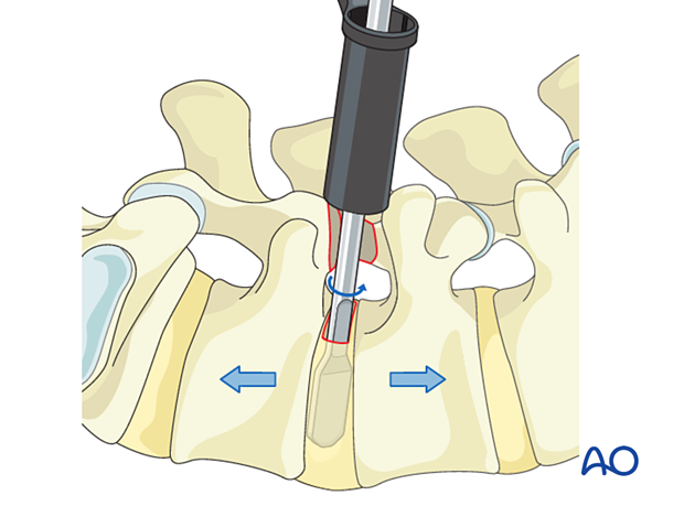 Distracting the disc space during MISS Transforaminal lumbar interbody fusion (TLIF)