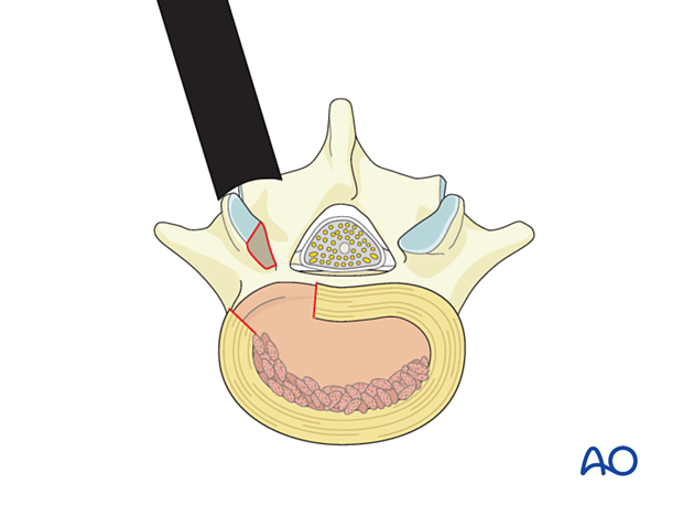 Packing bone graft into the discectomy space during MISS Transforaminal lumbar interbody fusion (TLIF)