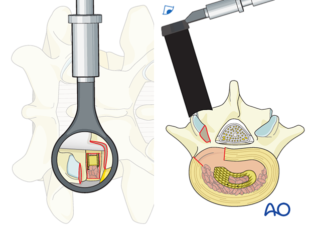 Confirming the appropriate positioning of the cage within the disc space during MISS Transforaminal lumbar interbody fusion (TLIF)