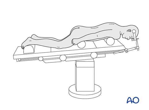 Patient in a prone position for approaches to C0–C7