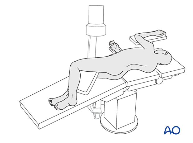 Patient in lateral decubitus with C-arm in lateral position