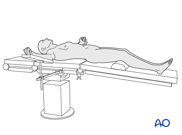 Patient in a supine position for Anterior lumbar interbody fusion (ALIF)