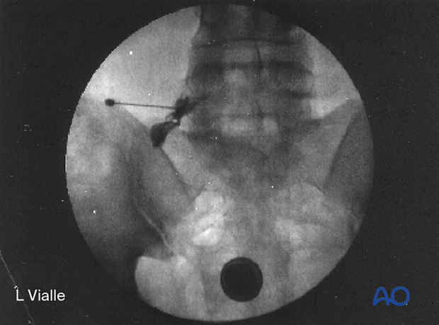 57b Pr040 Supine position for Anterior lumbar interbody fusion ALIF