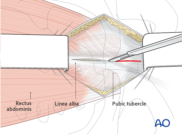 approach to the pubic symphysis