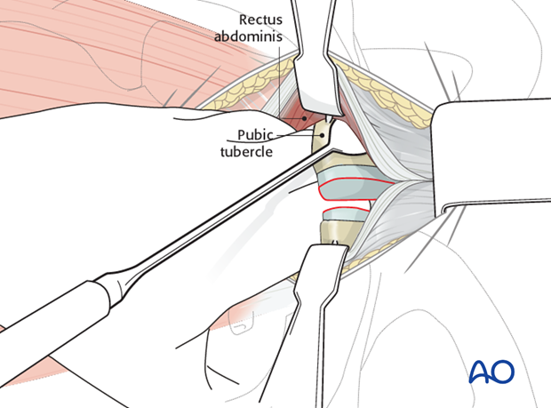 approach to the pubic symphysis