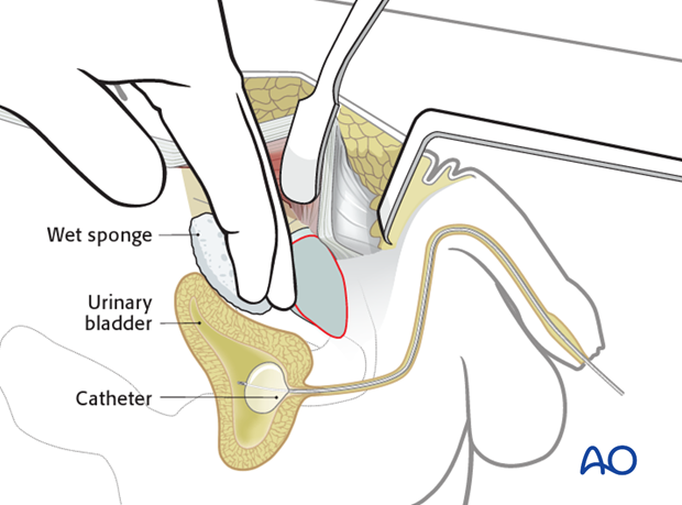 approach to the pubic symphysis