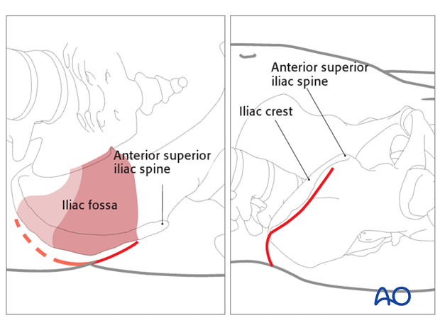 anterior approach to the iliac wing and si joint