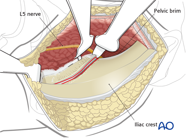 anterior approach to the iliac wing and si joint