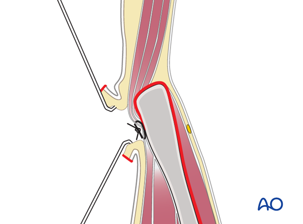 anterior approach to the iliac wing and si joint