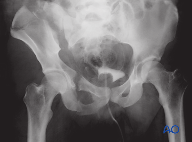 anterior approach to the iliac wing and si joint