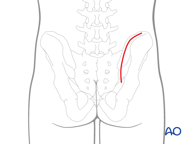 posterior approach to the si joint