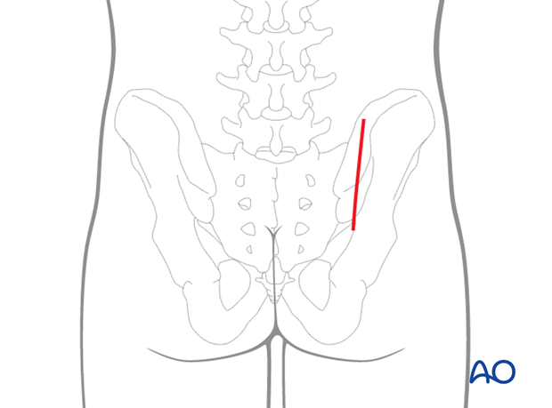 posterior approach to the si joint