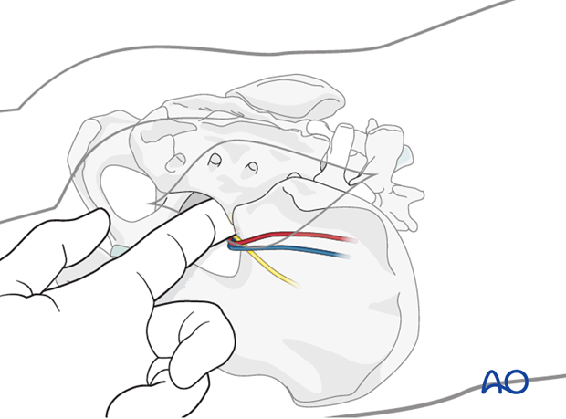 posterior approach to the si joint