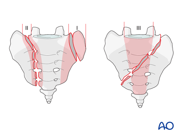 posterior approach to the sacrum