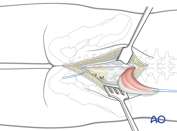 posterior approach to the sacrum