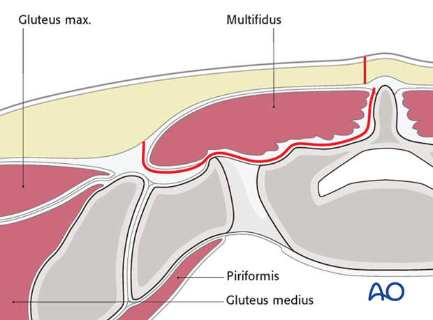 posterior approach to the sacrum