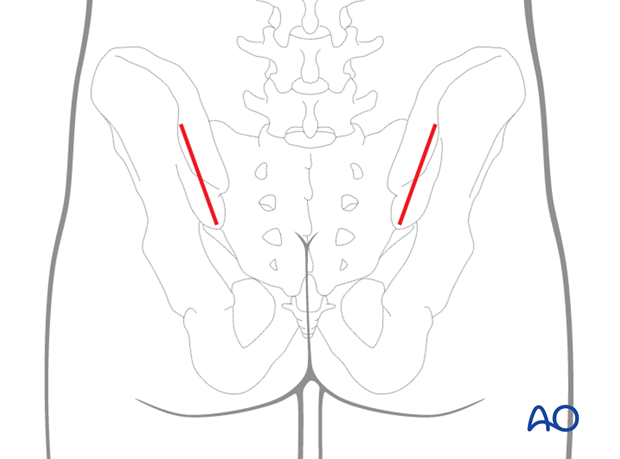 posterior approach to the sacrum