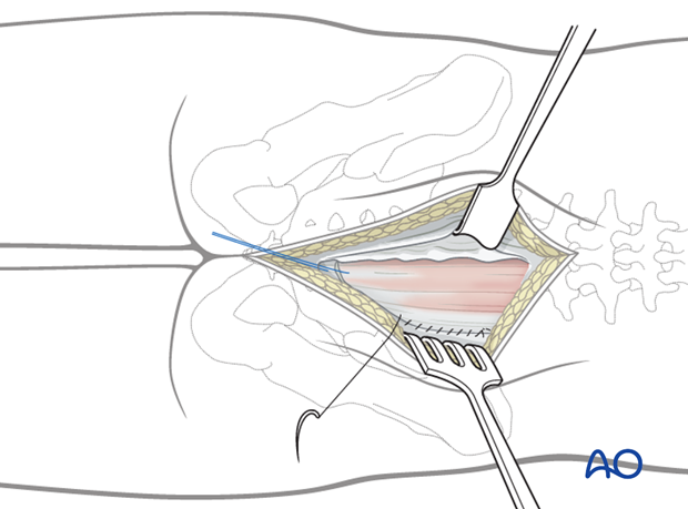 posterior approach to the sacrum