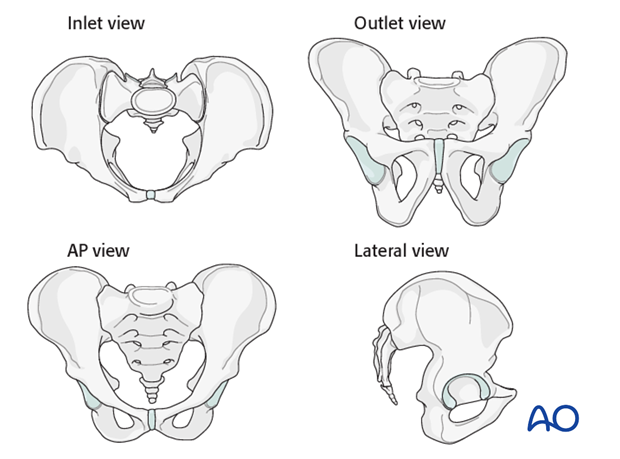 mio iliosacral screw for sacrum