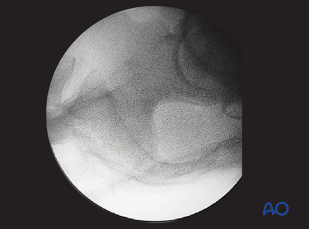 mio iliosacral screw for sacrum