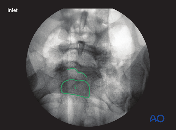 mio iliosacral screw for sacrum