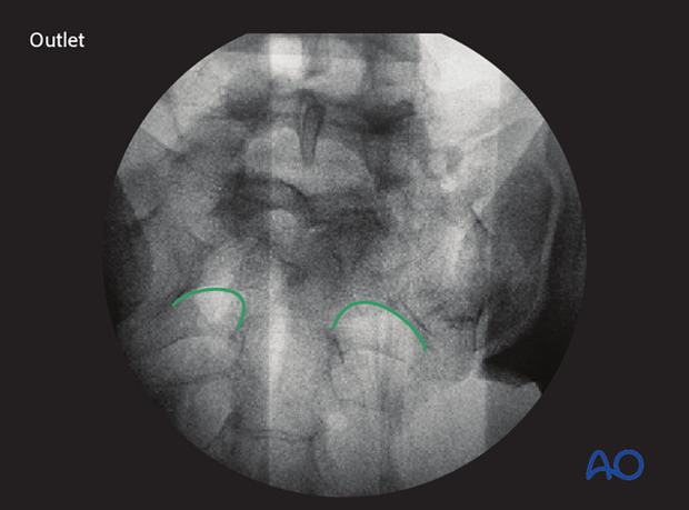 mio iliosacral screw for sacrum