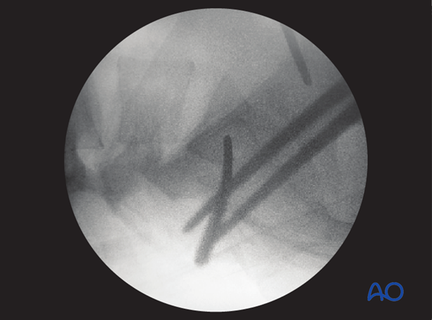 mio iliosacral screw for sacrum