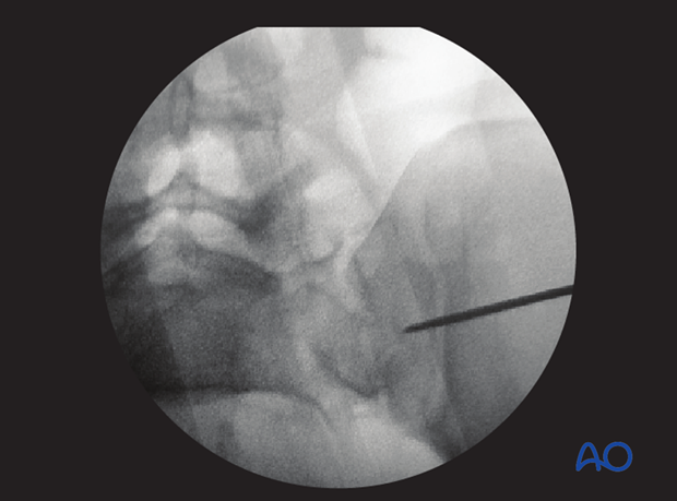 mio iliosacral screw for sacrum