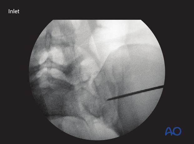 mio iliosacral screw for sacrum