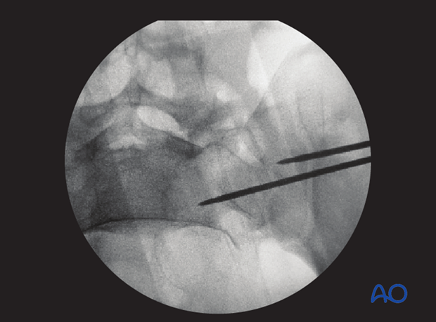 mio iliosacral screw for sacrum