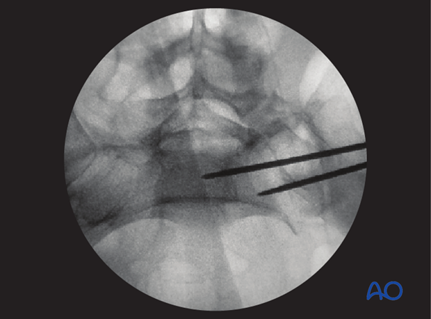 mio iliosacral screw for sacrum