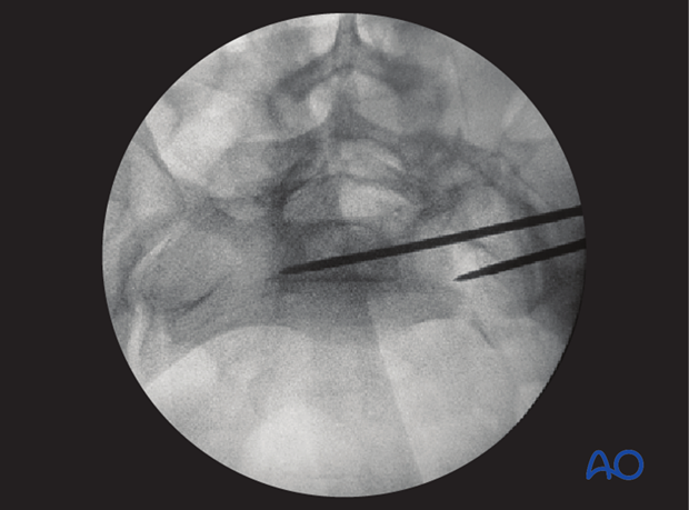 mio iliosacral screw for sacrum