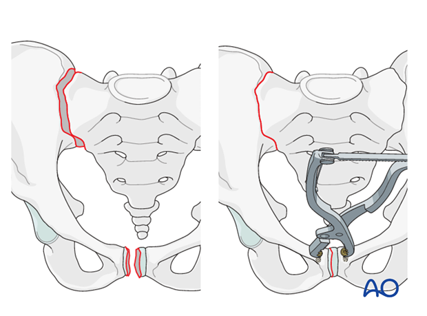 mio iliosacral screw for sacrum