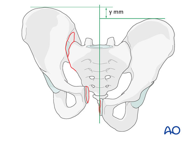 mio iliosacral screw for sacrum