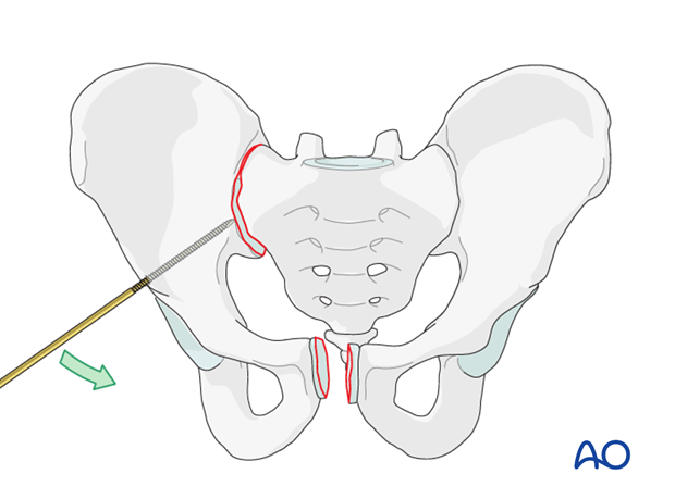 mio iliosacral screw for sacrum