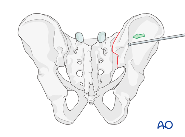 mio iliosacral screw for sacrum