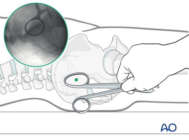 mio iliosacral screw for sacrum