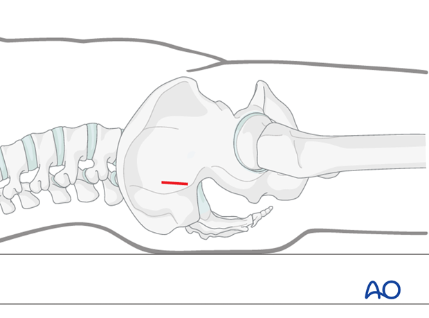 mio iliosacral screw for sacrum