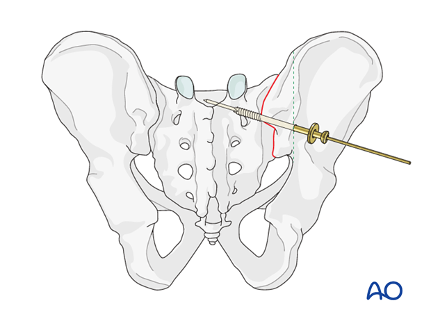 mio iliosacral screw for sacrum