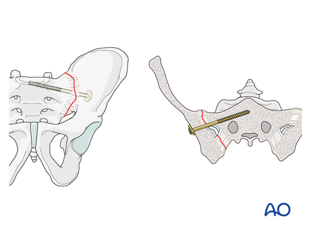 mio iliosacral screw for sacrum