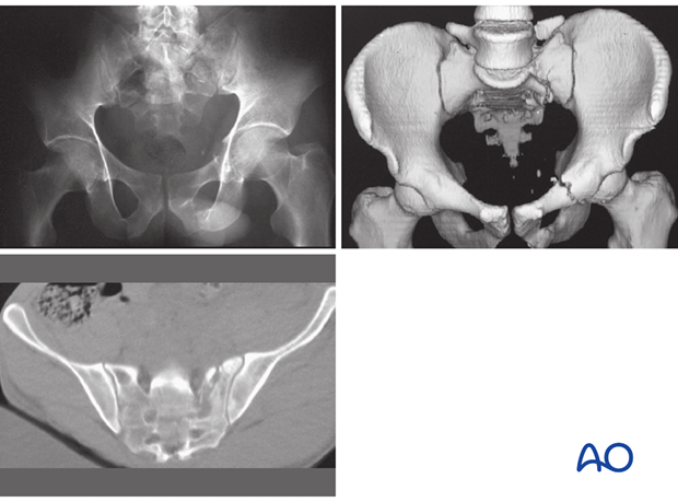 mio iliosacral screw for sacrum