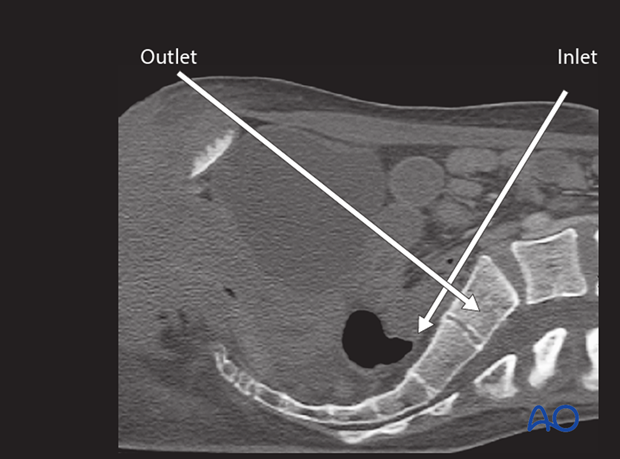 mio iliosacral screw for sacrum