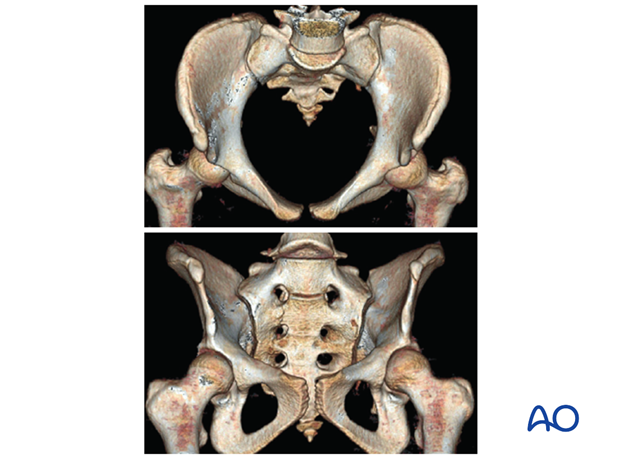 mio iliosacral screw for sacrum