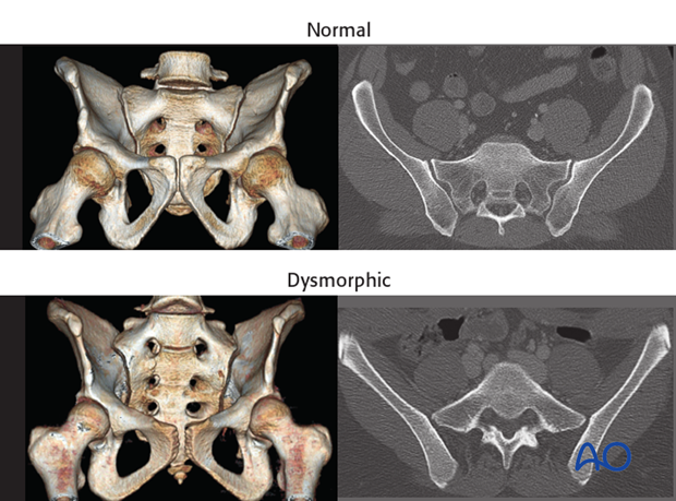 mio iliosacral screw for sacrum