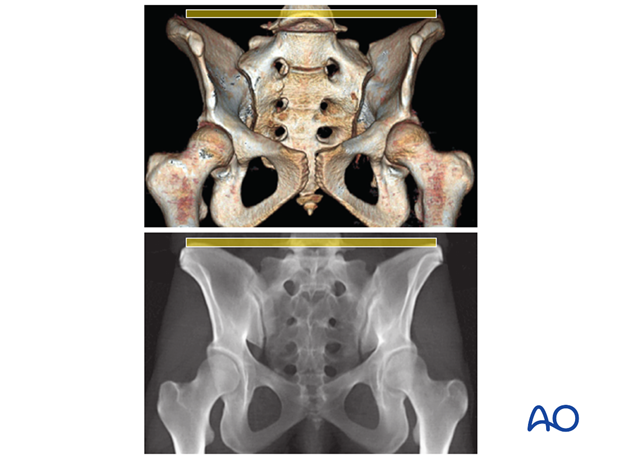 mio iliosacral screw for sacrum