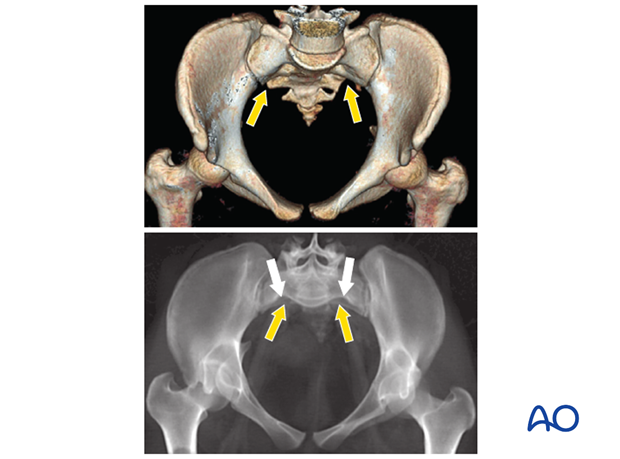 mio iliosacral screw for sacrum